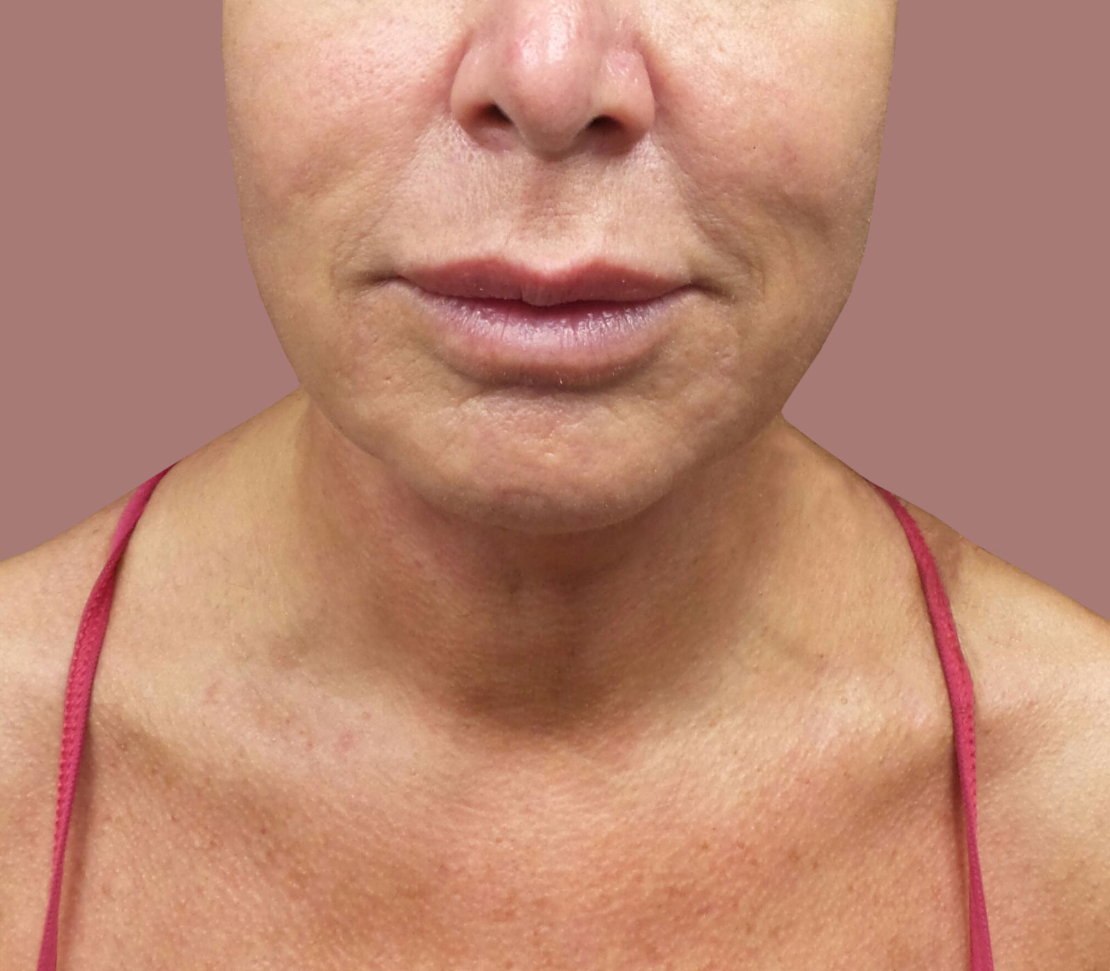 Facelift and Neck Lift near me