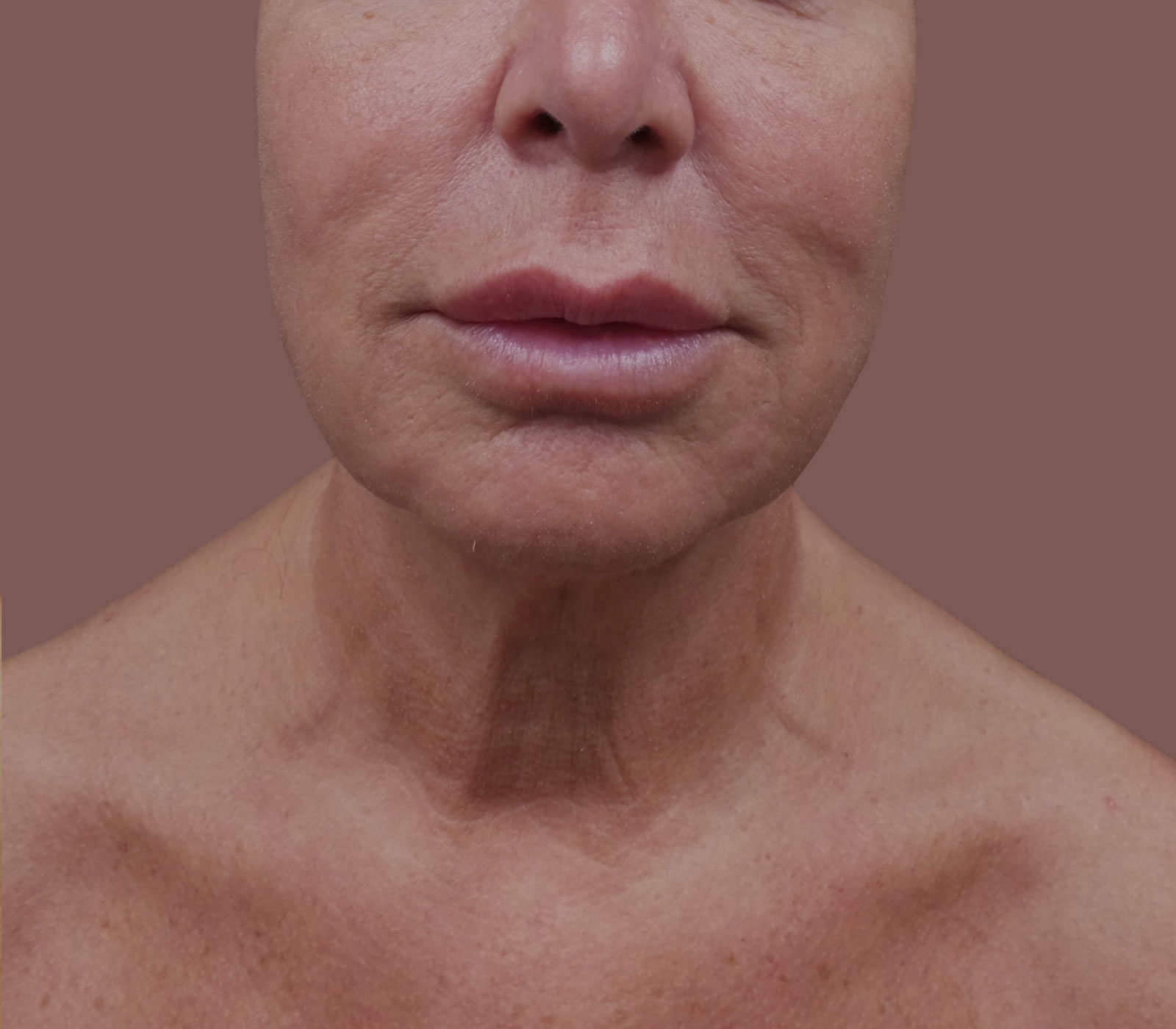 Facelift and Neck Lift long island